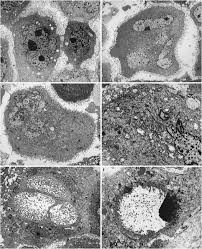 Download scientific diagram | transmission electron microscopy of a. Deciduoid Mesothelioma Report Of 21 Cases With Review Of The Literature Modern Pathology