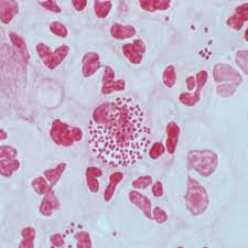Your doctor will likely do a urine test and confirmatory testing to determine if you have gonorrhea. Super Gonorrhea How Worried Do You Really Need To Be Self