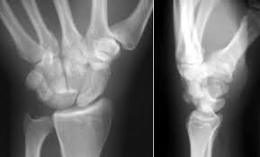 Image result for Scapholunate Dislocation
