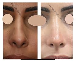 Dr Amr Nabil (@cairorhinoplasty_amr_nabil) • Instagram profile