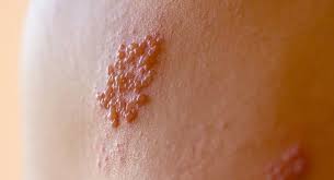 Image result for scabies on genitals