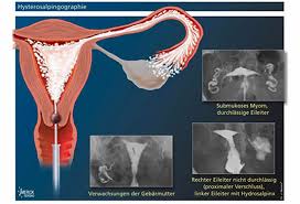Endometriosis is defined as endometrial glands and stroma that occur outside the uterine cavity. Fallopian Tube Diagnostics Kinderwunschteam Berlin