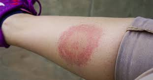 Bug Bite Black And Blue Ring What Are The Signs Of A Dangerous Bug Bite Passport Health