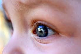 Abrupt onset of vision problems, such double vision. New App Can Detect Early Signs Of Eye Cancer In Kids News24