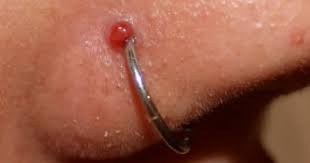 Keloids And Piercing Bumps Amato Fine Jewelry Body Piercing
