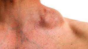 Image result for Lymphoma