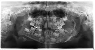 Clinical, radiologic, and histopathologic characteristics confirmed the diagnosis of cherubism. Early Detection Of Cherubism With Eventual Bilateral Progression A Literature Review And Case Report Sciencedirect