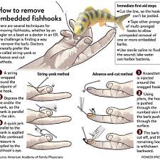 Image result for Fishhook Removal