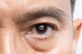 Image result for Cataract Extraction