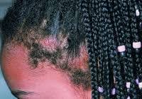 Tinea capitis tinea capitis or ringworm of the scalp is the most common cause of hair loss in children. Hair Loss In Children