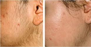 Laser hair removal treatment is an extremely safe and effective way to get the flawlessly smooth skin you have always dreamed of, but there are some things you should do before and after your laser treatment to ensure the best results with minimal side effects. Laser Hair Removal Results Laser Hair Removal Laser Hair Removal Results Ipl Hair Removal