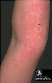 Read more about symptoms, diagnosis, treatment the reactions include sneezing, wheezing, cough, itching, skin rashes, stomach pain, diarrhea, or even a. Urticarial Rash Often Seen In Anaphylactic Reactions Picture Courtesy Download Scientific Diagram