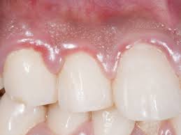 Swollen Gums: Causes, Treatments, And Home Remedies