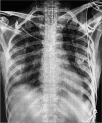 Image result for Transfusion Associated Circulatory Overload