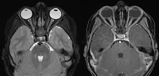 Image result for Optic Neuritis