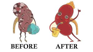 How To Flush Kidney Stones Naturally With Just Four Ingredients Anti Cancer Coconut Health Benefits Kidney Stones