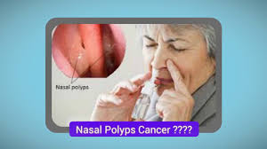 Which of the following is the polyps may develop during nasal or sinus infections and may disappear after the infection subsides. Nasal Polyps Cancer Is My Nose Polyps Cancerous Youtube
