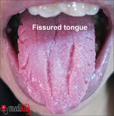 Image result for Fissured tongue