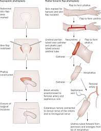 Male to female (mtf) before and after photos. Gender Reassignment Surgery An Overview Nature Reviews Urology
