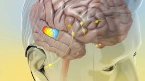 Tinnitus can be described as the experience of sound in the ear or in the head. Tinnitus Treatment Causes And Treatment Of Tinnitus Youtube