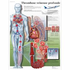 Thrombosis is the formation of a blood clot inside a blood vessel, obstructing the flow of blood through the circulatory system. Thrombose Veineuse Profonde 1001703 Vr2368l Cardiovascular System 3b Scientific