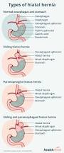 Image result for stomach hernia symptoms