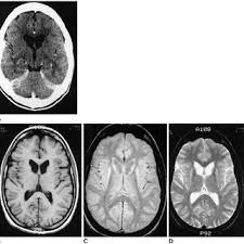Pdf Juvenile Huntington Disease Ct And Mr Features