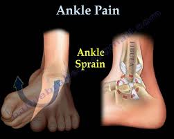 Nov 15, 2006 · ankle sprains can be classified as grade i to iii, depending on the severity of the injury.5 the most easily injured ligaments are the lateral stabilizing ligaments (i.e., anterior talofibular. Ankle Pain Ankle Ligaments Sprain Everything You Need To Know Dr Nabil Ebraheim Youtube