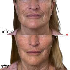 Just absolutely beautiful results yet again with Bellafill! ✨ Bellafill is  perfect for filling in deep lines and wrinkles and also great for areas  like the cheeks to create a beautiful lift!