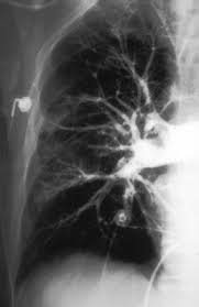 Chest Xray Cxr Confirming A Pulmonary Embolism Pe Cardiac Nursing Radiology Imaging Pulmonary Embolism