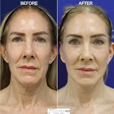 LOWER FACELIFT & NECKLIFT: This stunning 57 year old woman came to Dr.  Cooper seeking improvement to her lower face, jawline and neck. Dr.  Cooper's #deepplanefacelift and #deepplanenecklift restore youthfulness for  women