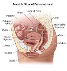 Most often this is on the ovaries, fallopian tubes, and tissue around the uterus and ovaries; Endometriosis Johns Hopkins Medicine