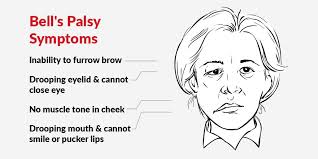 Bell's palsy is seen more commonly in areas where aids or sarcoidosis are more prevalent, but its incidence overall throughout the world remains constant. Drooping Face How To Treat Bell S Palsy With Physiotherapy