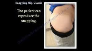 Snapping Hip Classic Everything You Need To Know Dr Nabil Ebraheim Youtube