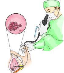 We did not find results for: How Do Doctors Find Bladder Cancer Bladder Cancer Advocacy Network