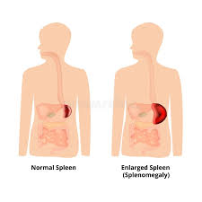 Image result for Splenomegaly