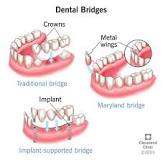 Dental Bridges: Types & Who Needs Them