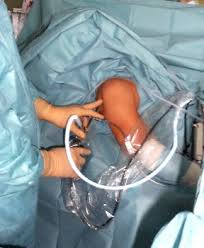 Bizepssehnen Riss Therapie Lange Bizepssehne Operation Pro