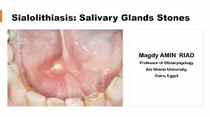 Image result for Sialolithiasis