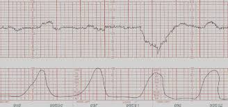 Deviceefm Implementation For Fetal Heart Monitor Issue 2 Tanjera Infirmary Integrated Github