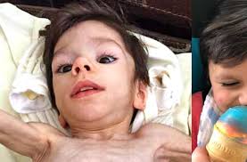 Emaciated boy makes incredible transformation after he's adopted: 'He was  bones and skin'