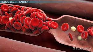 Blood Clot In The Foot Symptoms Signs Treatment Video Lesson Transcript Study Com