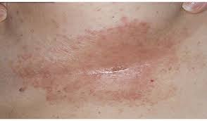 It is mostly a form of irritant dermatitis and is called intertrigo here are the top 10 ways to get rid of a rash under your breasts. Pin On Ayurvedic Tips