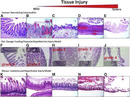 Image result for Necrotizing Enterocolitis