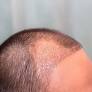 hair transplant in islamabad from www.royalcosmeticsurgery.com.pk
