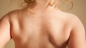 Do You Have A Rash From Hay Fever Symptoms And Treatments Skin Allergies Dermatitis Treatment Severe Eczema