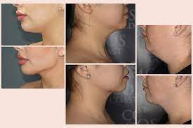Most non surgical approaches to treating sagging neck and jowl tissues center around tightening the skin. Neck Liposuction Costs And What To Expect