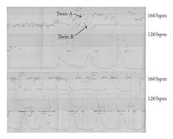 Fetal Heart Rate Patterns In Monochorionic Twins Following