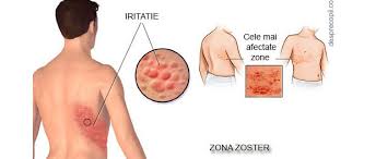 După ce o persoană a avut varicelă, virusul rămâne latent. Zona Zoster