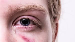 Brennende Augen Die Haufigsten Ursachen Chip